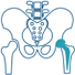 Anterior Hip Replacement