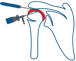 Arthroscopic Rotator Cuff Repair
