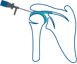 Arthroscopic Subacromial Decompression