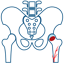 Avascular Necrosis of the Hip