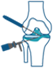 Knee Arthroscopy
