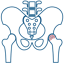 Osteoarthritis of the Hip