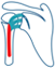 Proximal Biceps Tendinitis